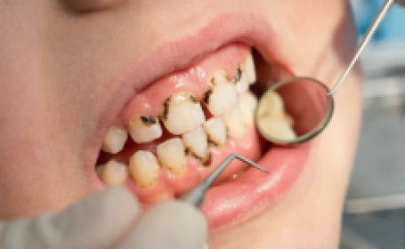 Черный налет на зубах у детей - фото