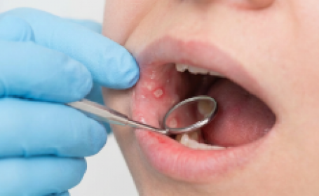 Стоматит: что это такое и как избавиться - фото