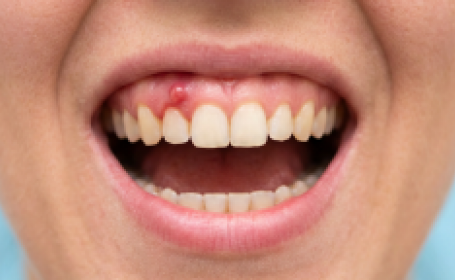 Свищ на десне: что это такое и как от него избавиться? - фото