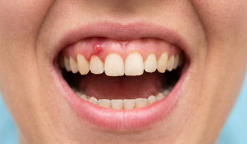 <p>Проблемы с деснами многие предпочитают не замечать, игнорируя дискомфорт,&nbsp; откладывая визит к стоматологу до последнего. Но важно не затягивать и при первых неприятных ощущениях сразу идти в клинику.</p>

<h2>Почему на десне появляется свищ?</h2>

<p>Часто развитие воспалительного процесса провоцирует плохая гигиена, кариес, пульпит. Из-за этого в ротовой полости размножаются бактерии. Постепенно в мягких тканях слизистой накапливается гной и образуется канал для его выхода. Внешне это похоже на красную шишку с белой точкой.</p>

<p>Другие возможные причины — повреждение десны (например, при хирургических вмешательствах), неправильная установка коронки или зубы мудрости, которые не могут прорезаться.</p>
 - фото