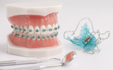 Зубные пластины и брекеты: как выбрать подходящий метод коррекции прикуса - фото