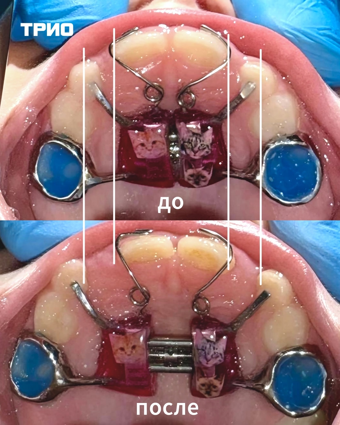 Установка аппарат Марко Росса.