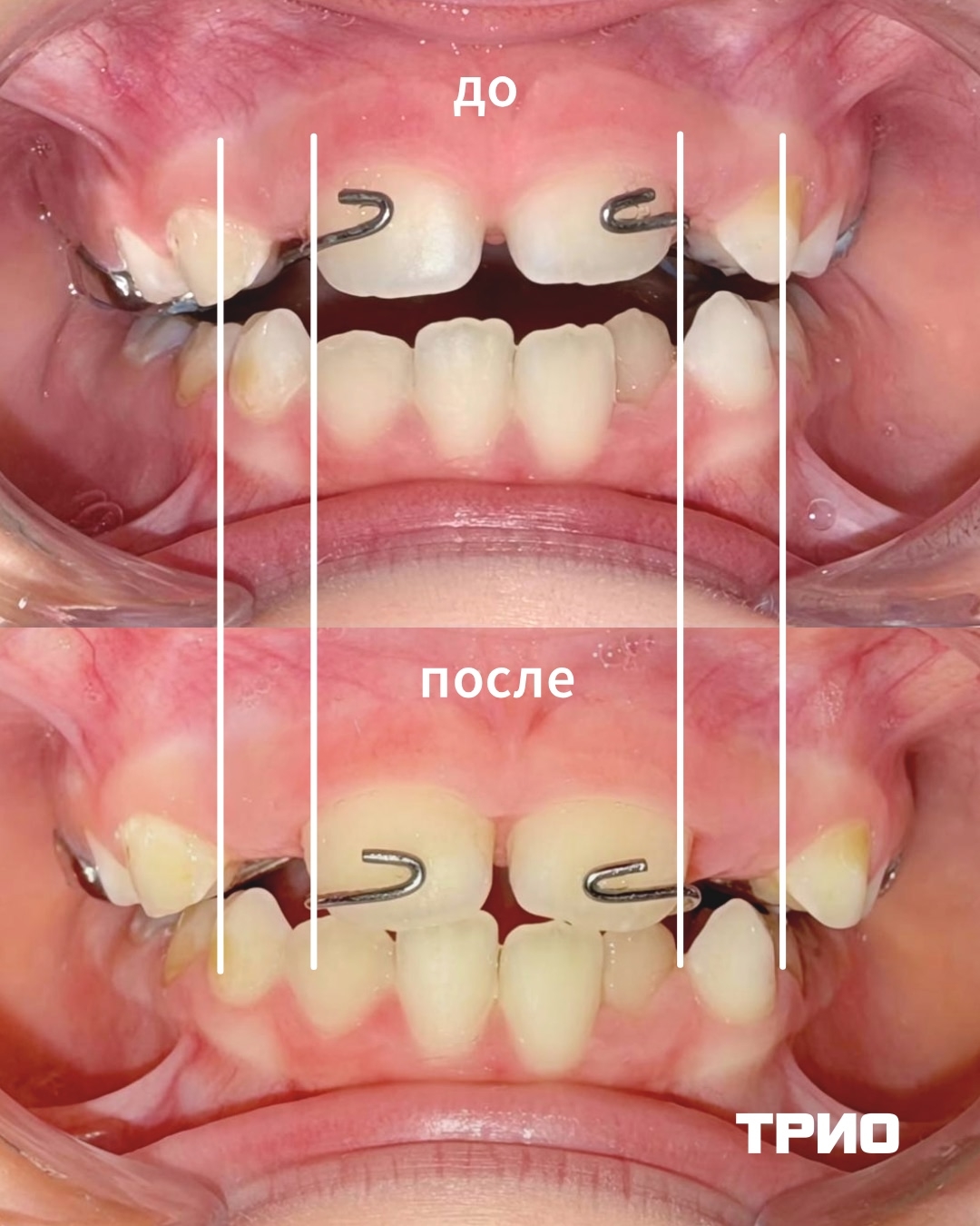 Установка аппарат Марко Росса.